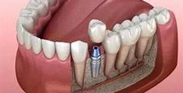 Dental implant sample