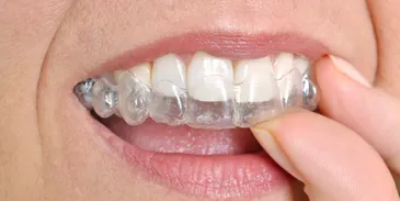 A mouth with invisible braces.