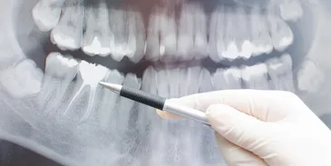 Pen pointing at dental xray